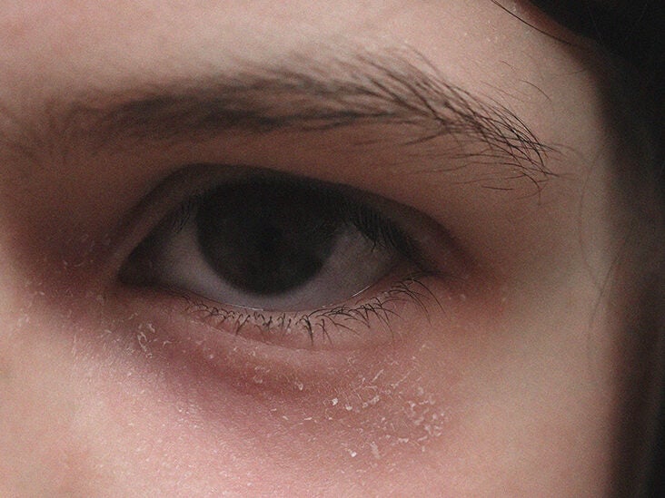 around the eyes: Causes, symptoms, treatment