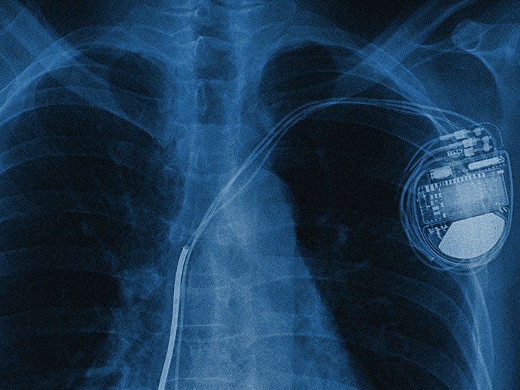 How Much Does A Pacemaker Cost With Insurance? 