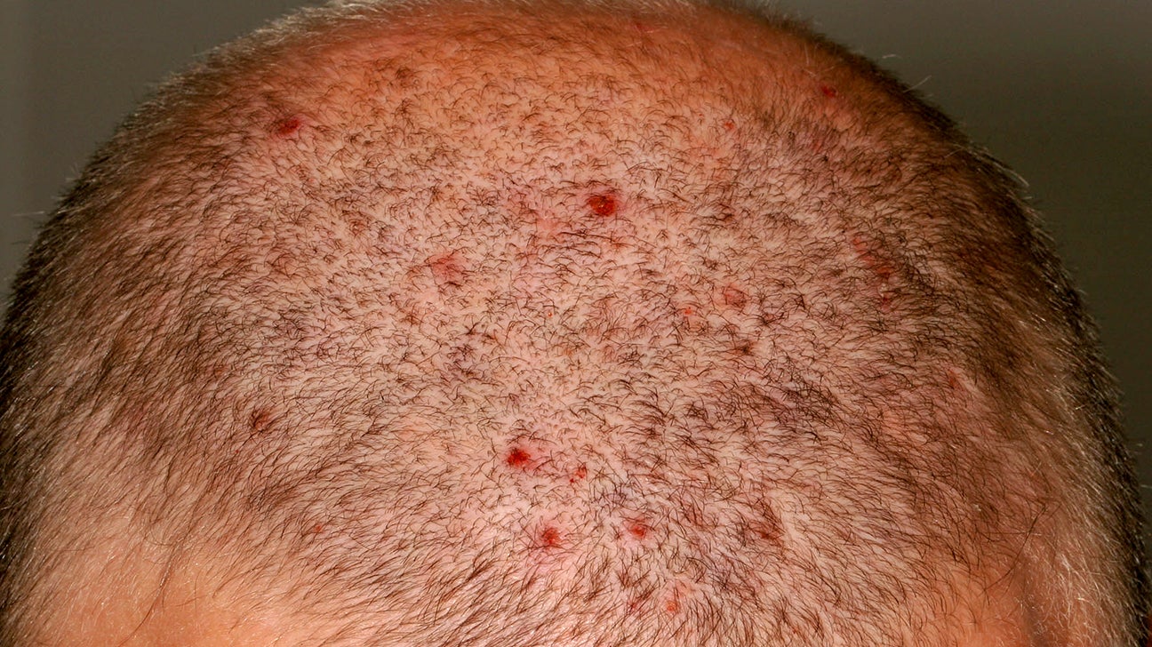 Bumps on the scalp: Causes, symptoms, and treatments