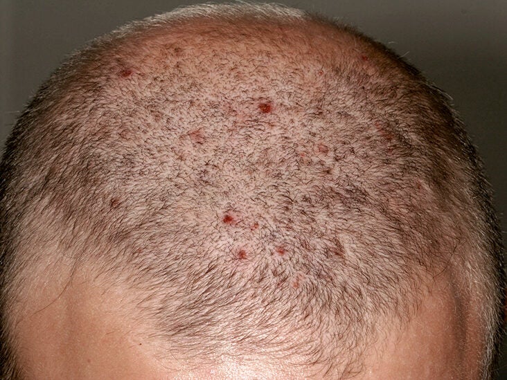 Sores and scabs on scalp: Causes, treatment, and prevention