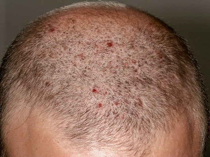 Bumps On The Scalp Causes Symptoms And Treatments   Moderate Scalp Folliculitis Original Thumb 