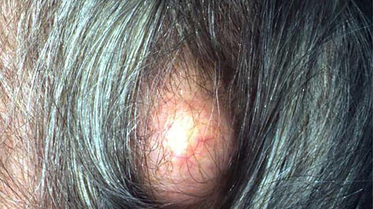 Bumps on the scalp: Causes, symptoms, and treatments