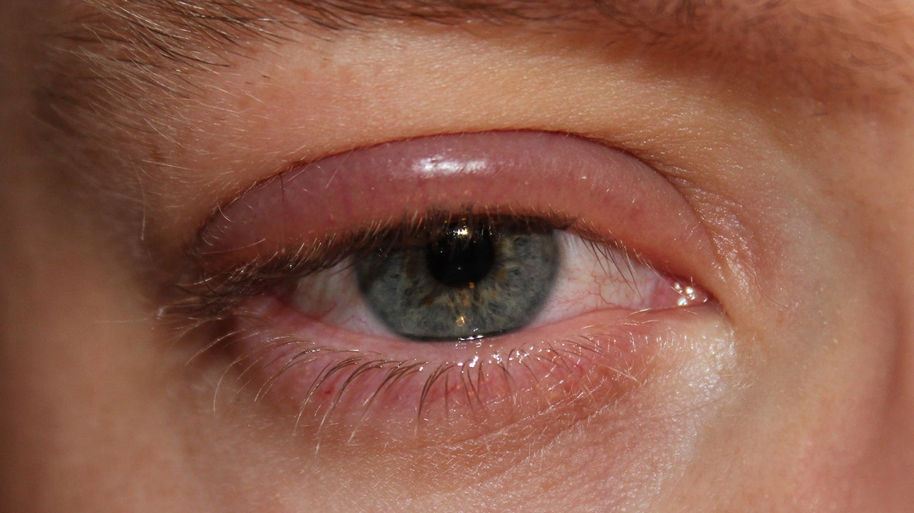 Swollen eyes, dark circles, red and burning eyes