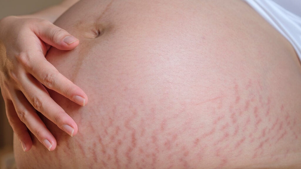 Is there a name for those stretch marks that occur in women's t