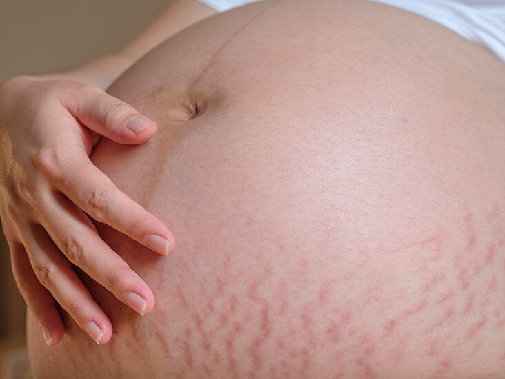 stretch marks after pregnancy on black women