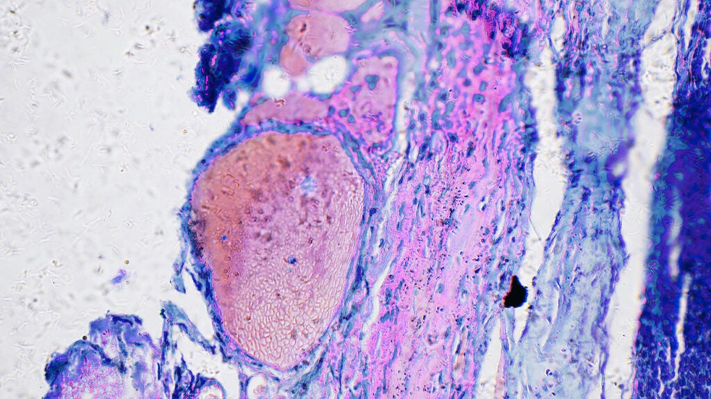 How does cancer kill you?