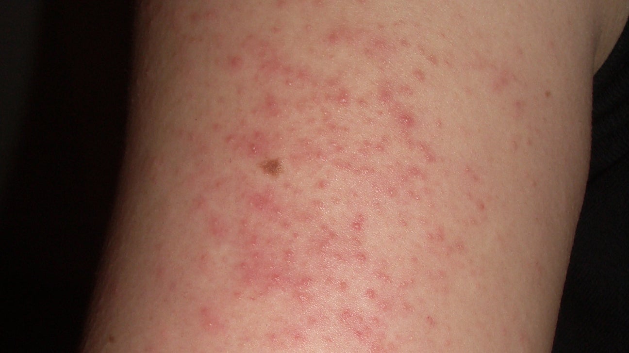Red dots on Pictures, causes, treatment, and when help