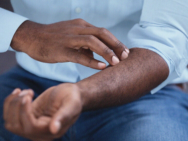 Dermatophagia: Symptoms, causes, and treatment