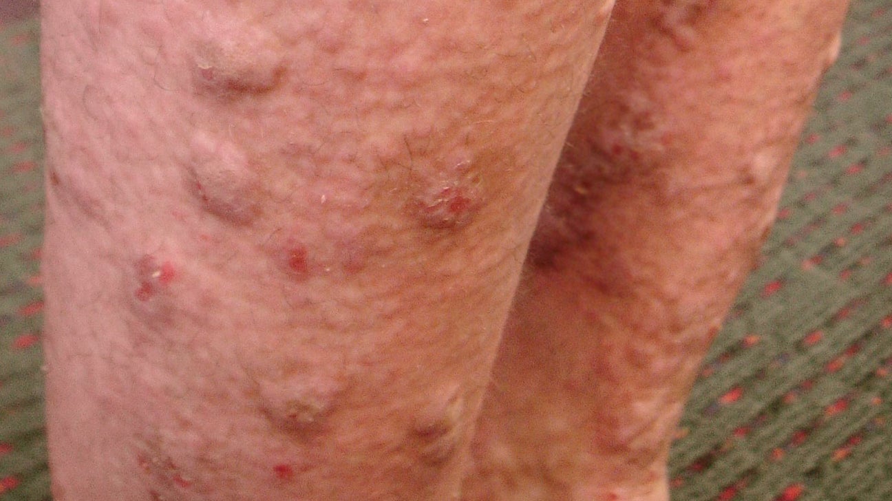 hiv rash chest