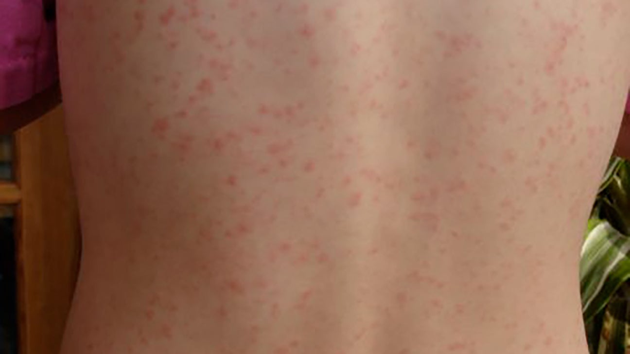 Høring Forslag Pas på Red dots on skin: Pictures, causes, treatment, and when to seek help