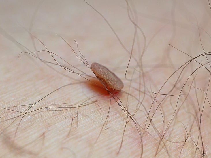 What Does A Non Cancerous Skin Tag Look Like