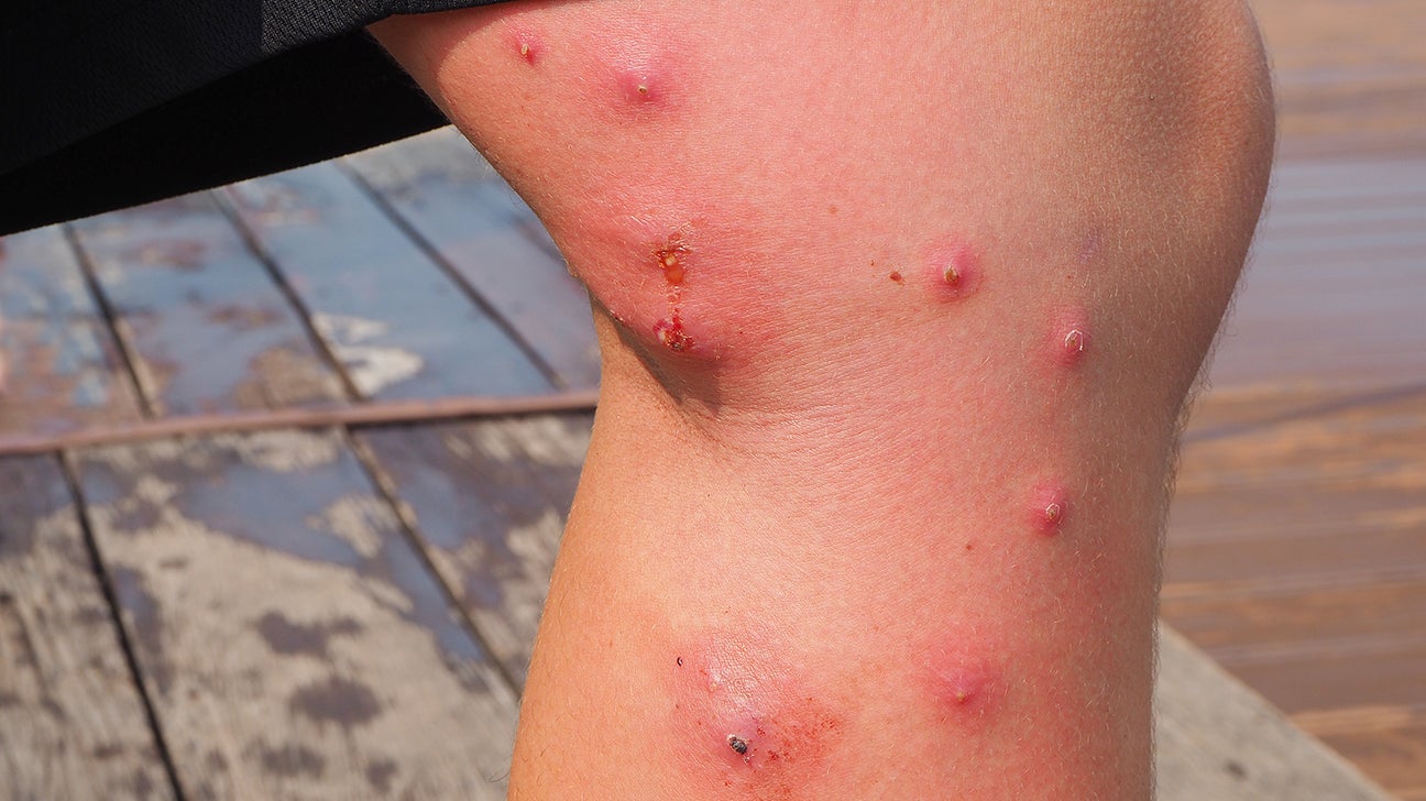 Infected Insect Bite Pictures Symptoms Treatment And More