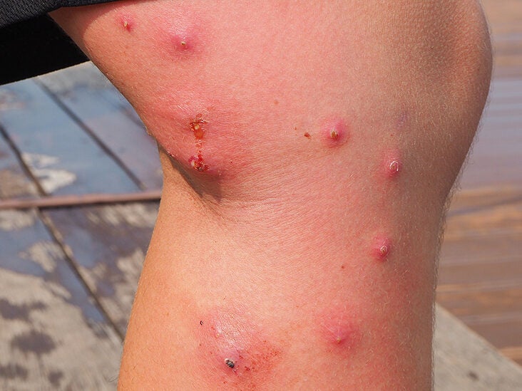 insect bites red marks