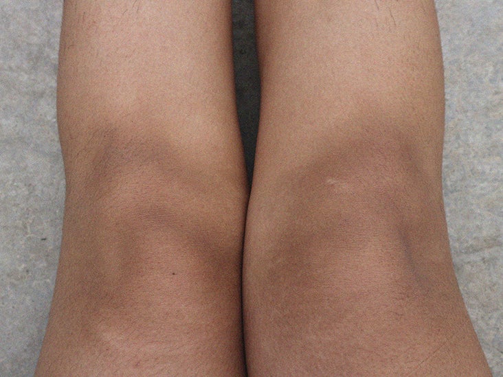 dark-knees-causes-and-home-treatment