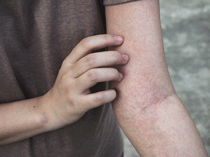 Non blanching Rash Is It Serious Causes In Adults And Children