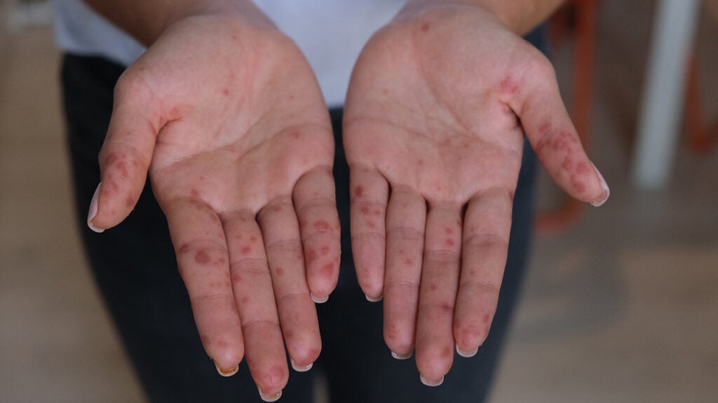 Hand, foot, and mouth disease in adults Symptoms and treatment