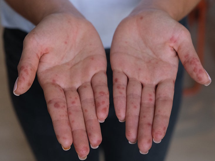 hand foot and mouth disease adults face