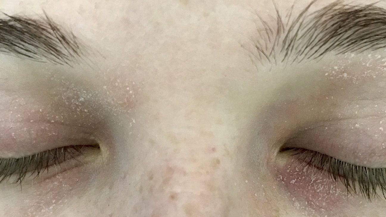 Red Rings Around Eyes Pictures Causes Symptoms And Treatment Red Rings Around Eyes Pictures Causes Symptoms And Treatment