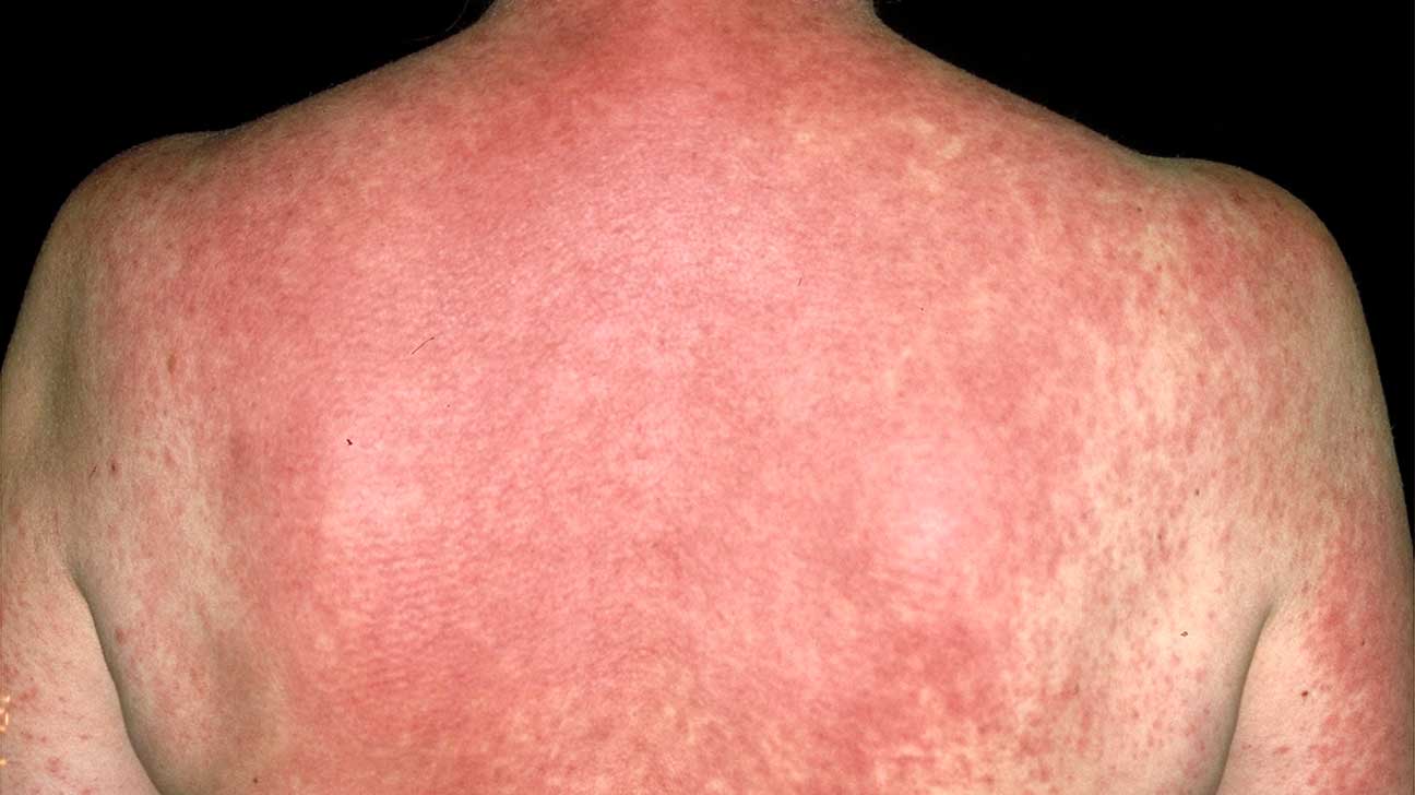 can-skin-rash-cause-swollen-lymph-nodes