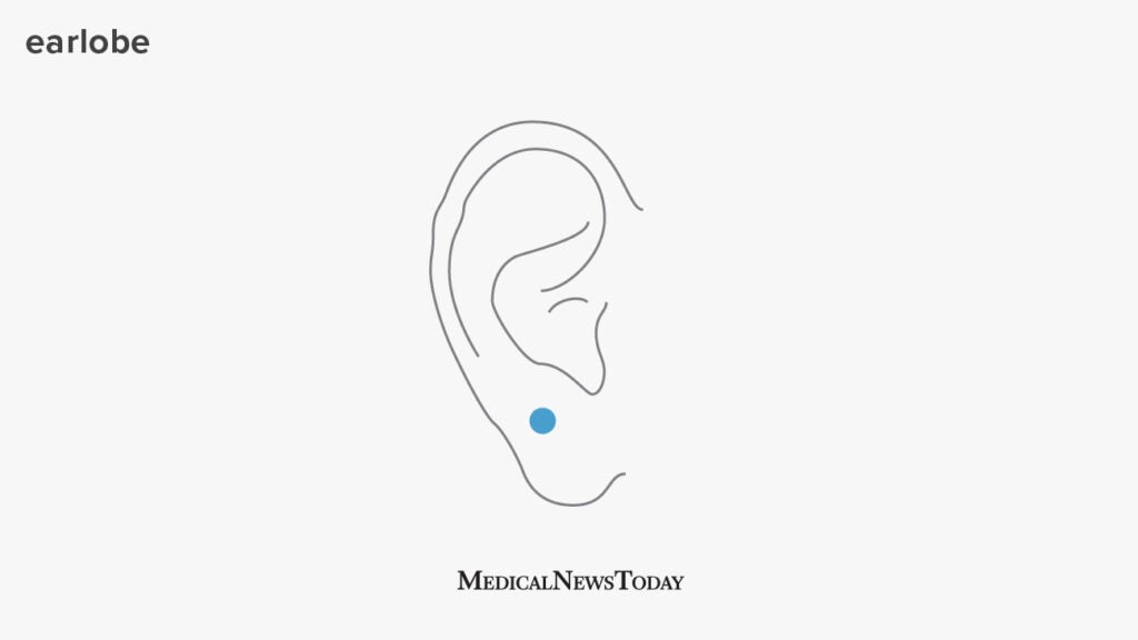 Ear pressure points for migraine relief, tinnitus, and more