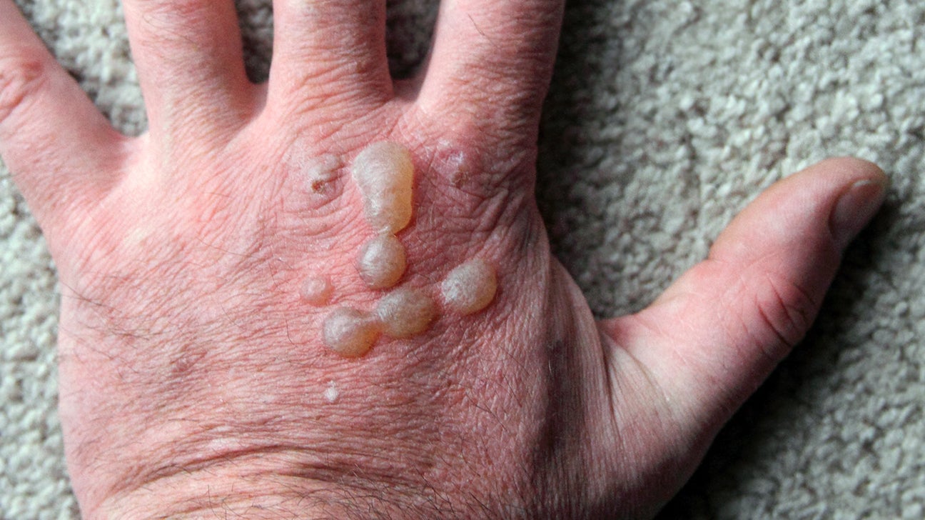 skin blister type rash