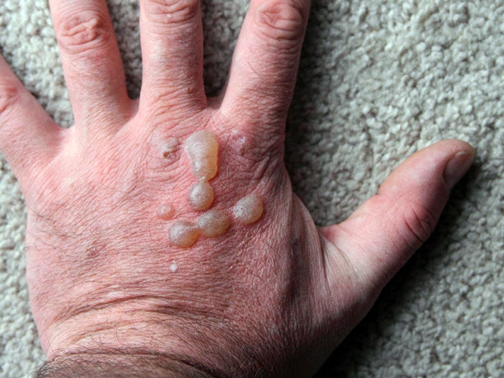 translucent skin hands