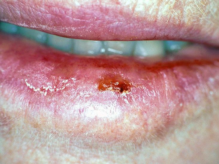 how to treat swollen lip after dental work