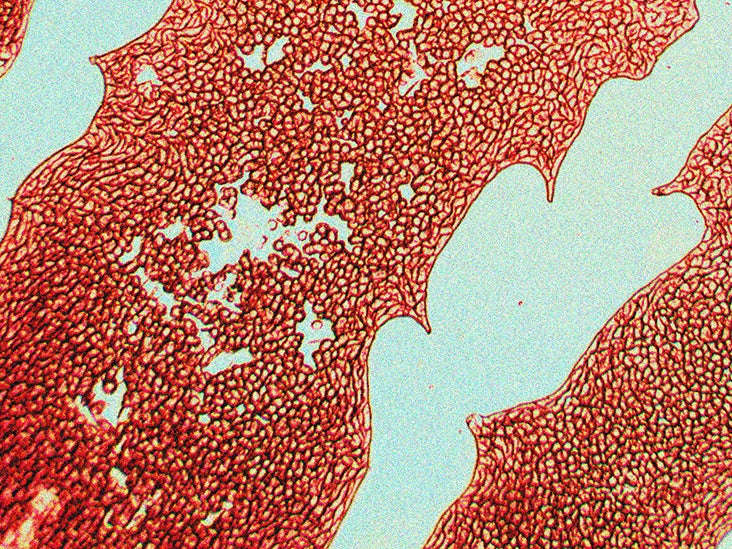 University of California, San Francisco: Lung Shaped Blood Clot