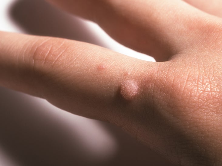 human papillomavirus infection on finger