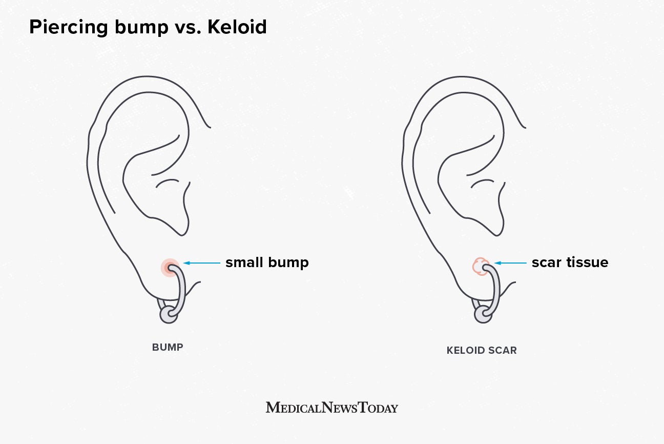 Keloid Earrings Pressure Clip Scar Treatment for Piercing Bump