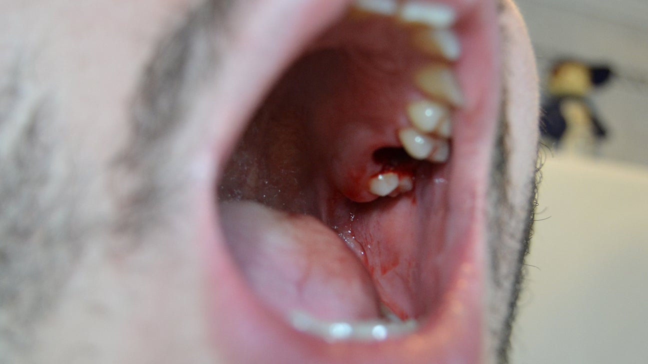 wisdom tooth extraction hole