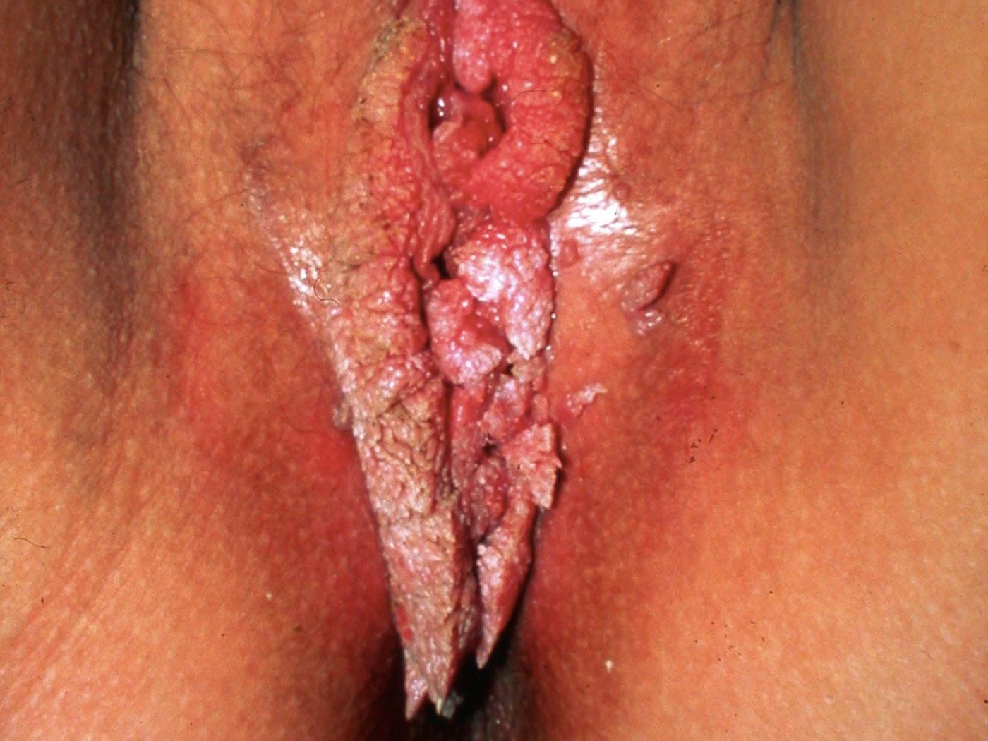 чем можно заразится сифилисом при мастурбации фото 27