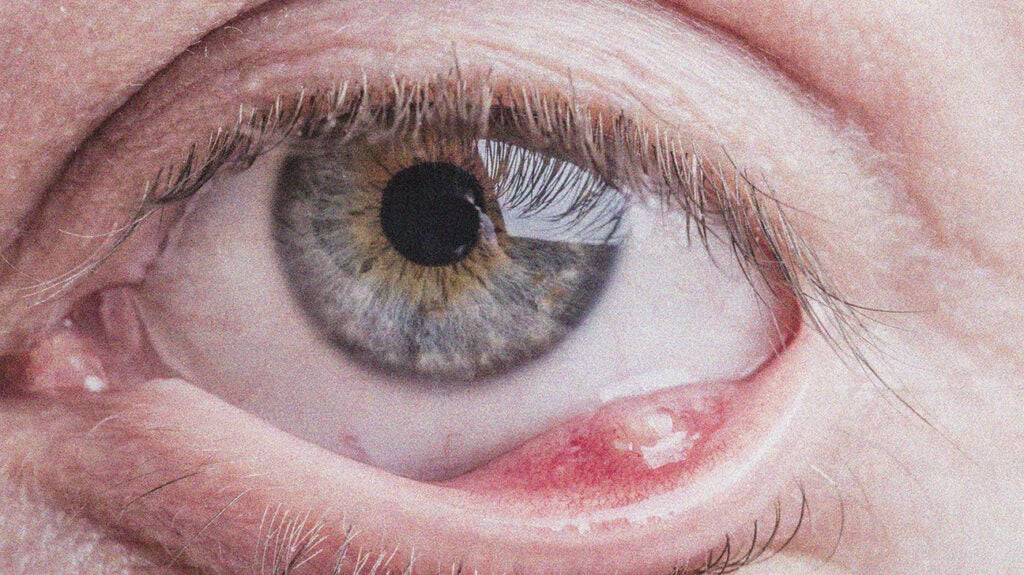 Stye Inside Eyelid (internal Stye): How To Identify, And Treatments