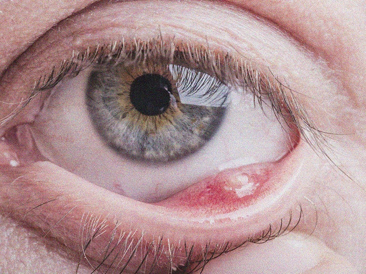 Stye Inside Eyelid internal Stye How To Identify And Treatments