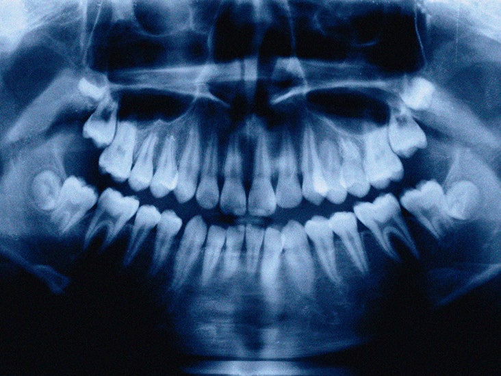 Calcium deficiency and teeth: Signs, treatment, and complications