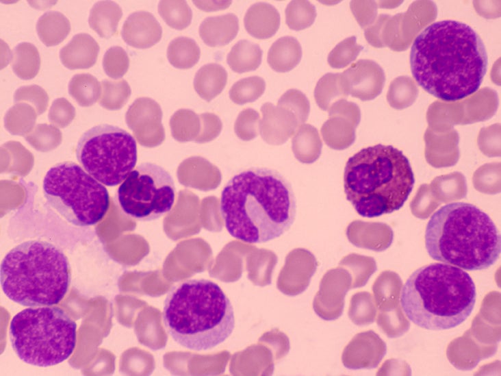 Types of leukemia: Prevalence, treatment options, and prognosis