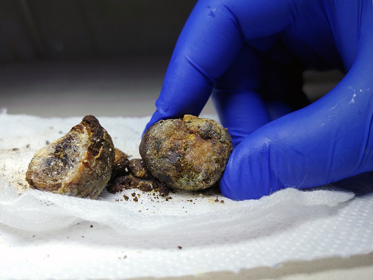 gallstones in poop