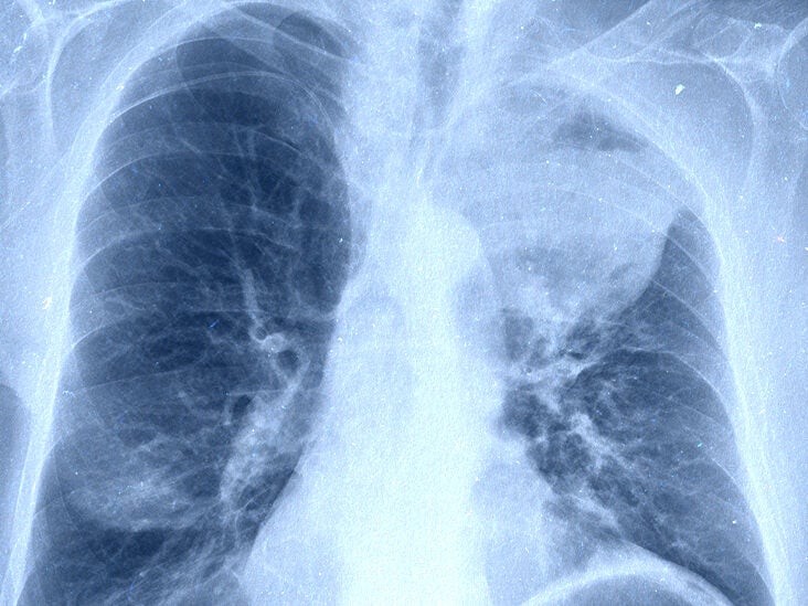 How Quickly Does Lung Cancer Spread Your Faqs