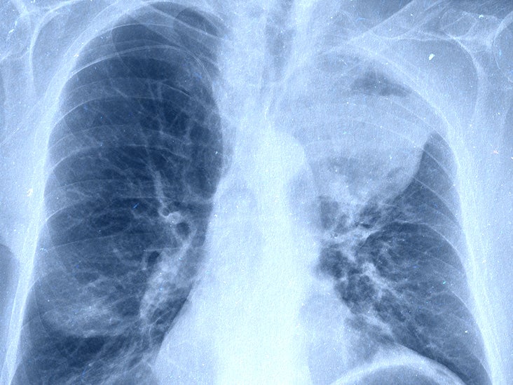 aggressive cancer in lungs paraziți în tratamentul și prevenirea corpului uman