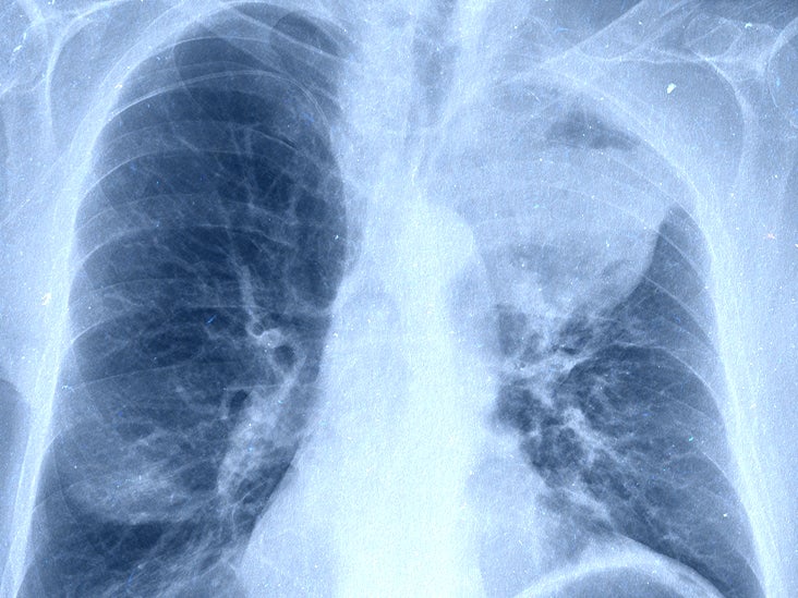 aggressive cancer in lungs