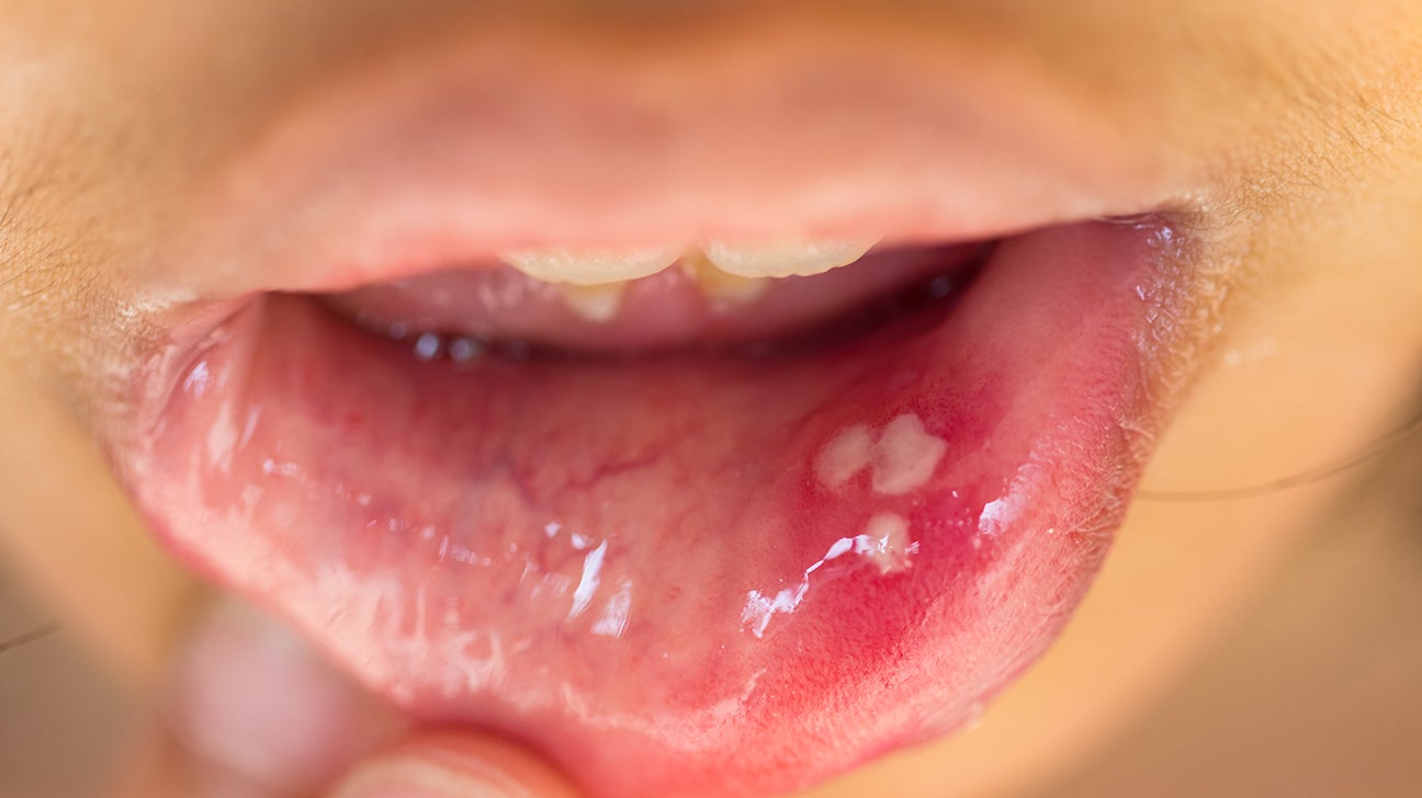 papilloma growth on tongue