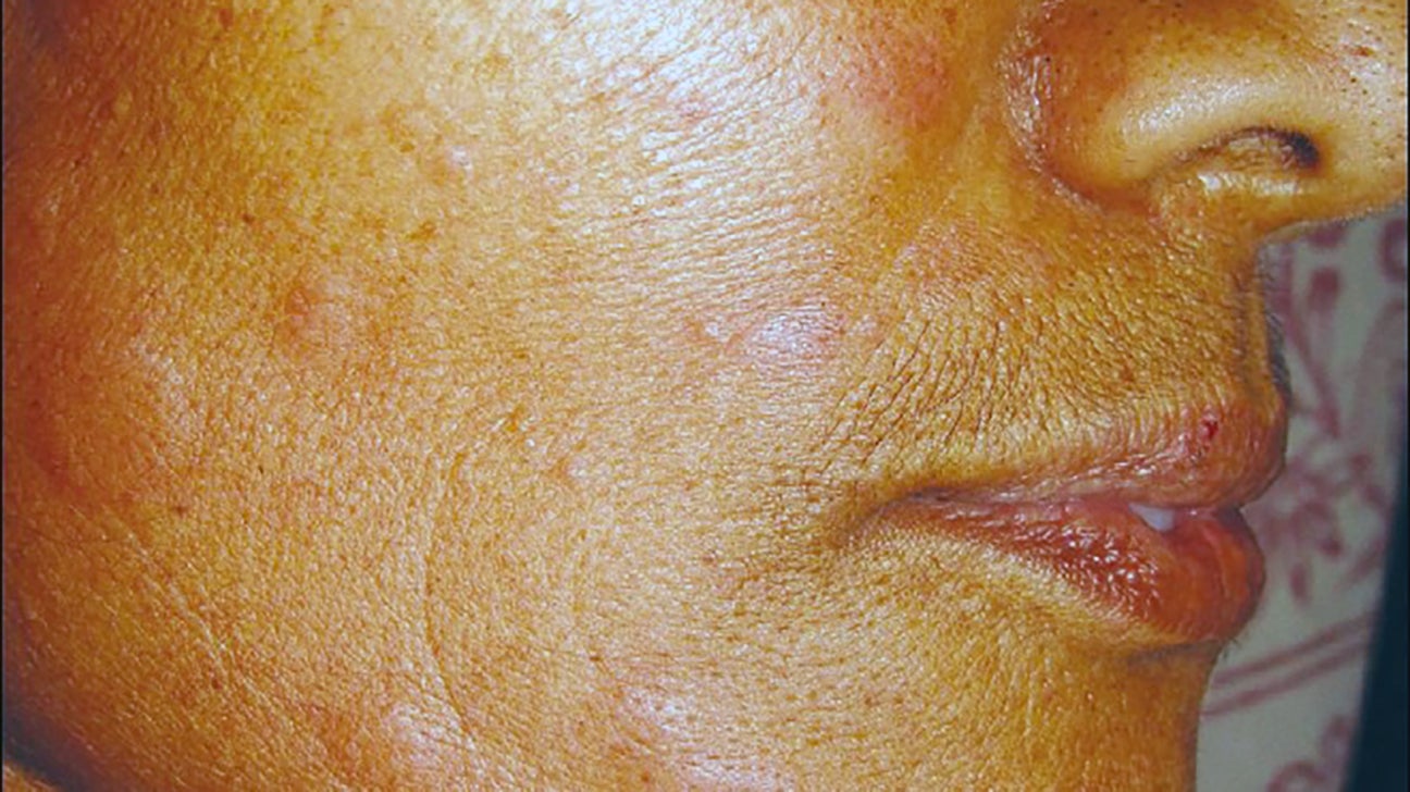 Hives on face: Treatments, causes, and outlook