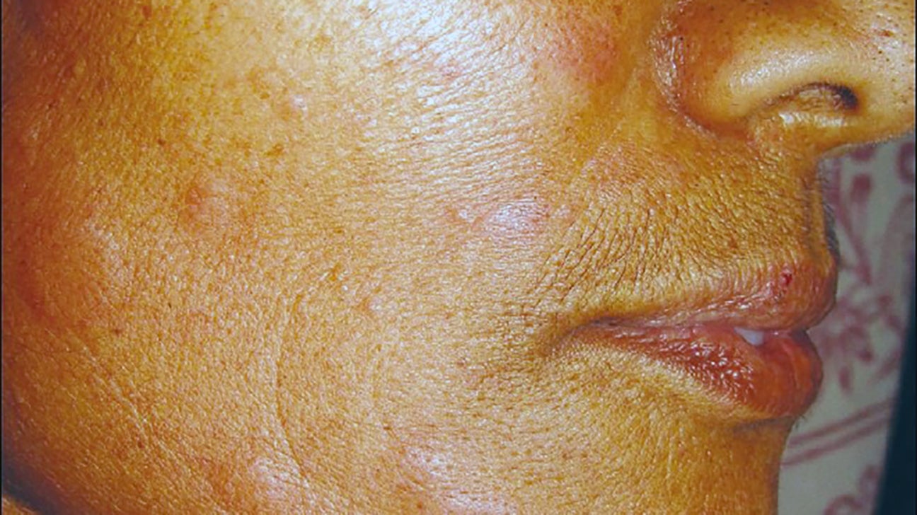 How to treat face rash from allergic reaction