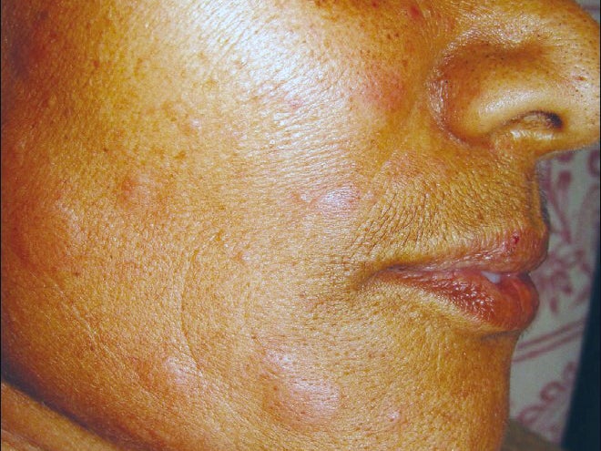 urticaria rash): Treatment, symptoms, and more