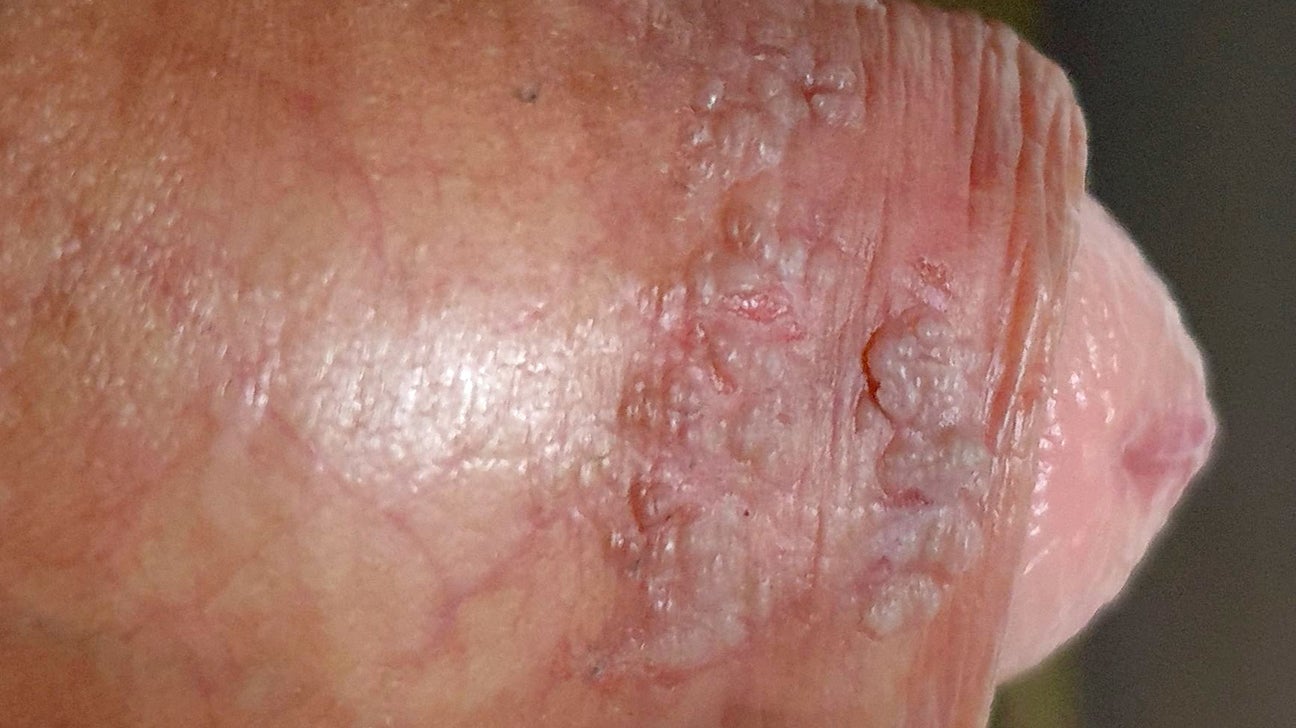 hpv skin problems