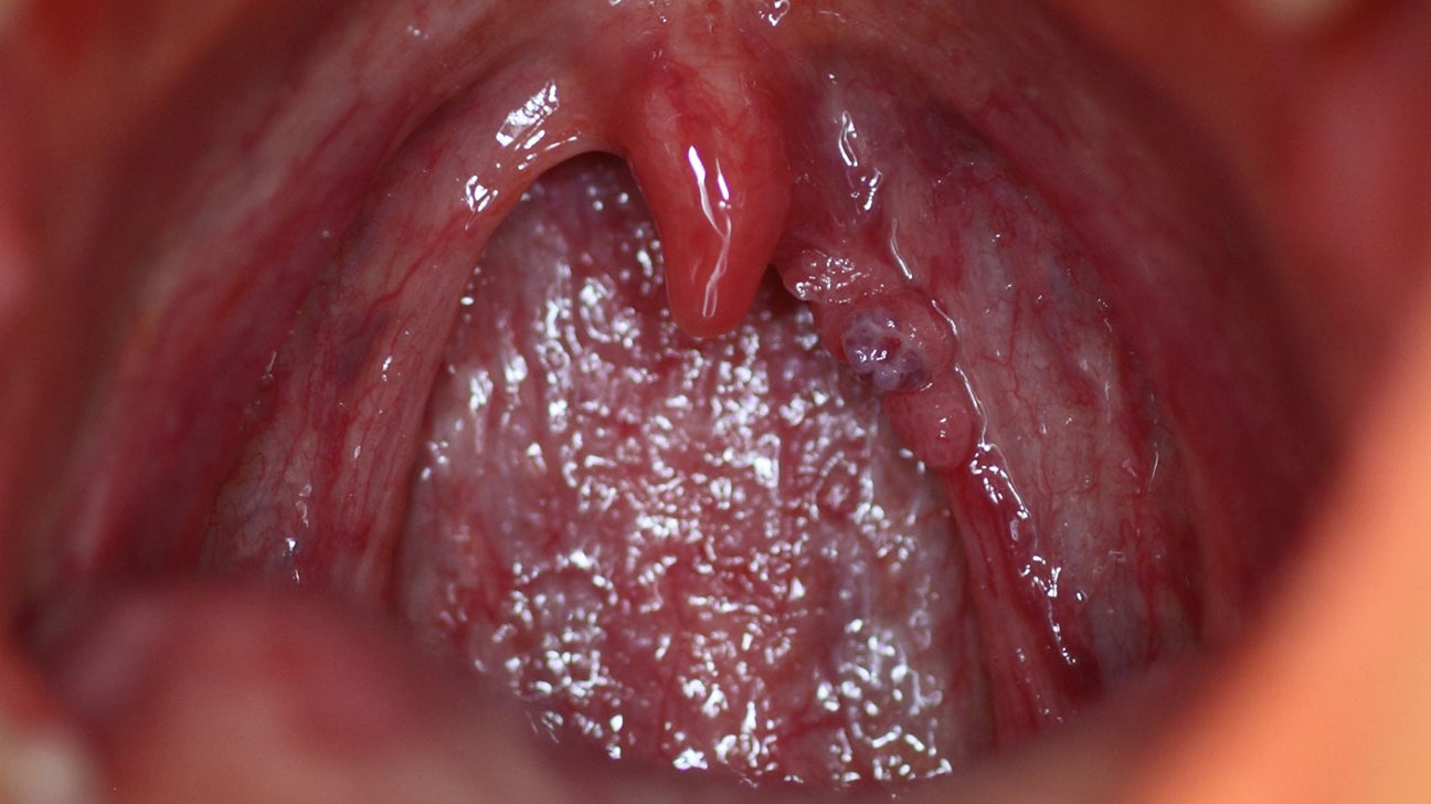 Papillomavirus related lesion Hpv with lesion