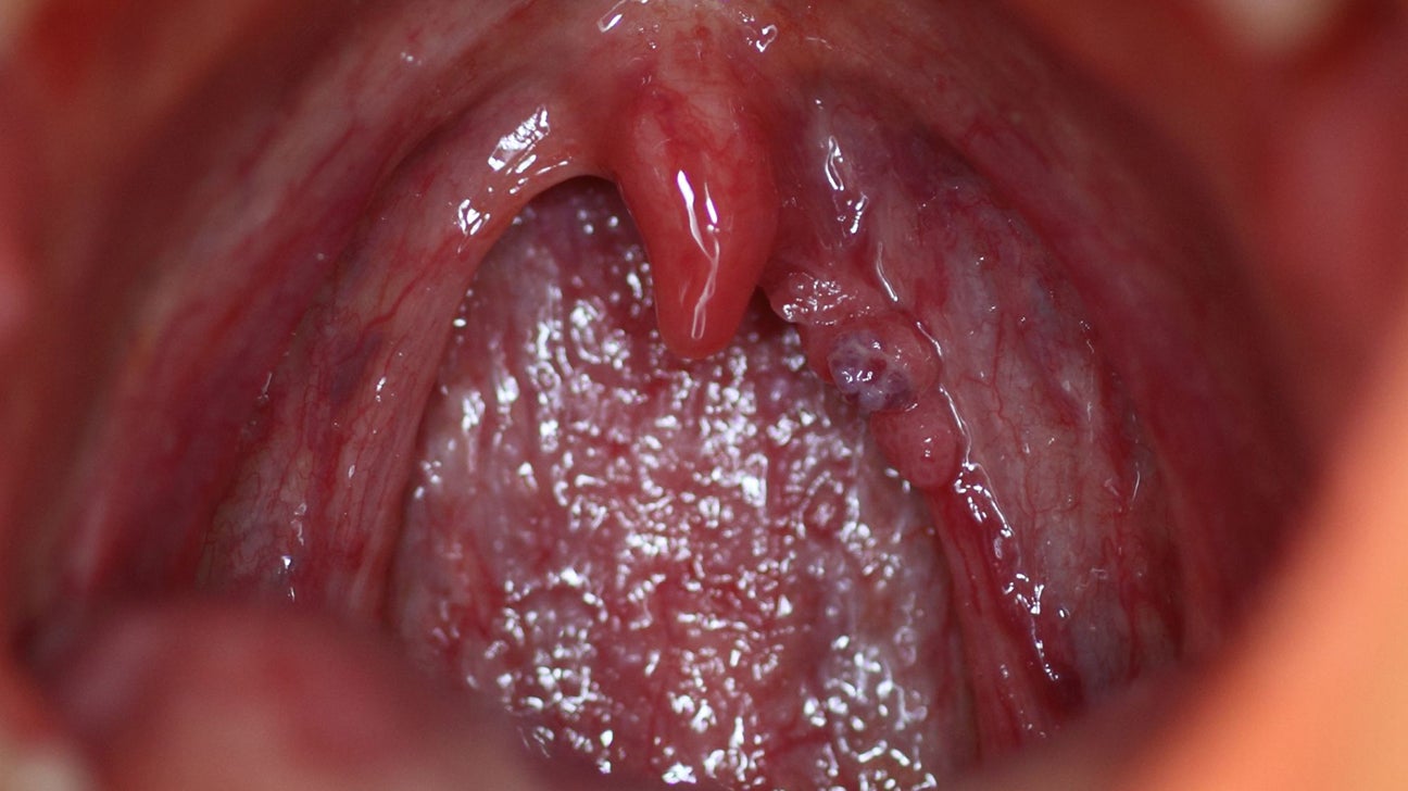 hpv symptoms of the throat condiloame și naștere