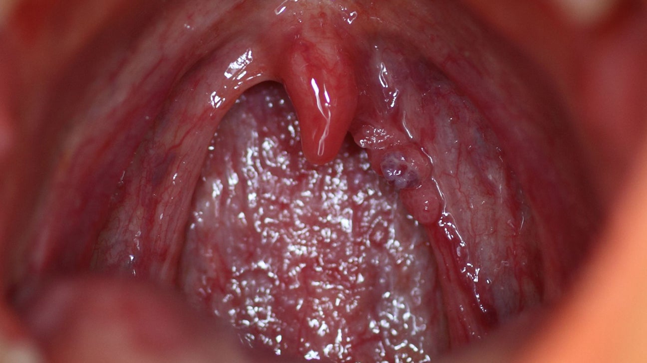 Hpv symptoms on mouth