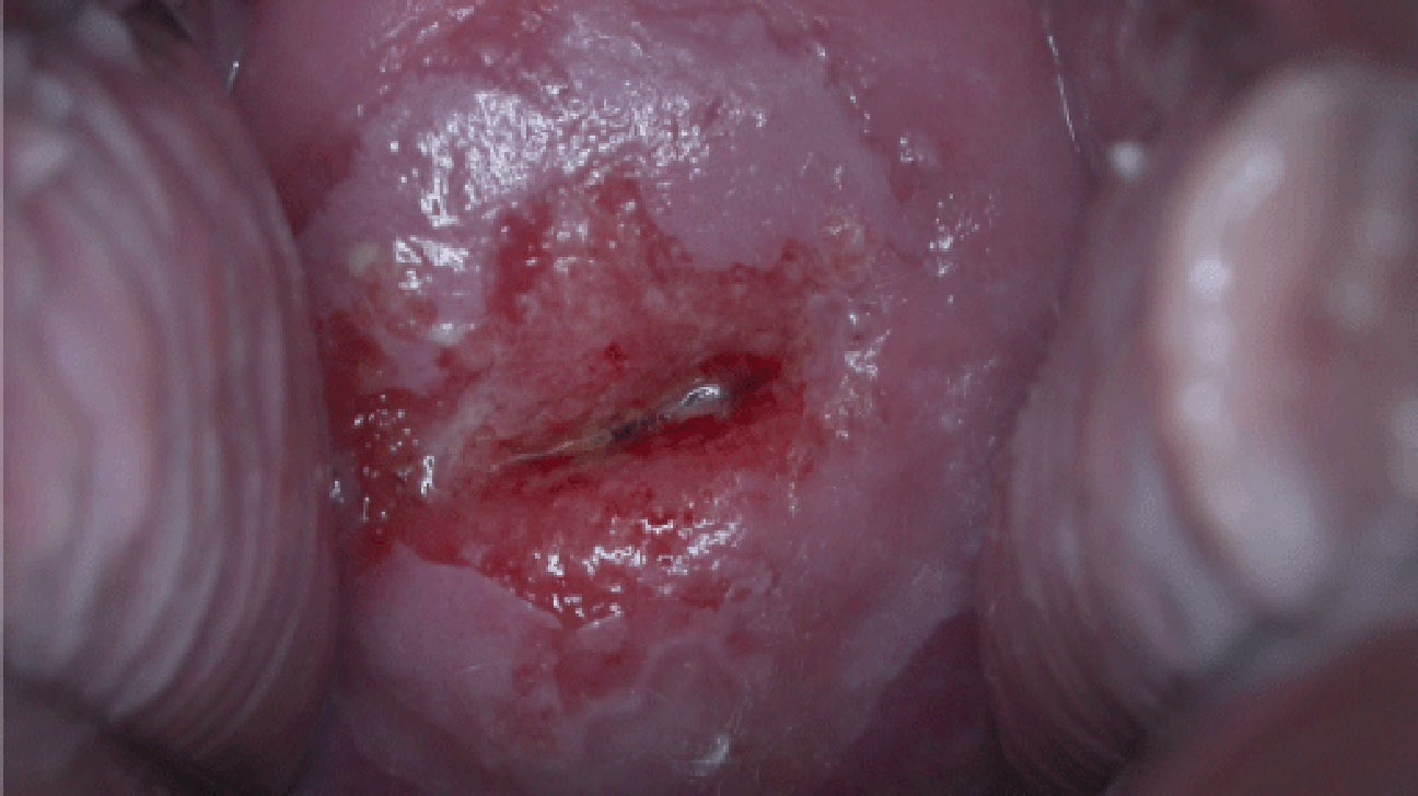 human papillomavirus genital ulcers
