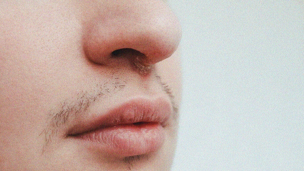 Cold Sore Under Nose Symptoms Causes Treatments And More
